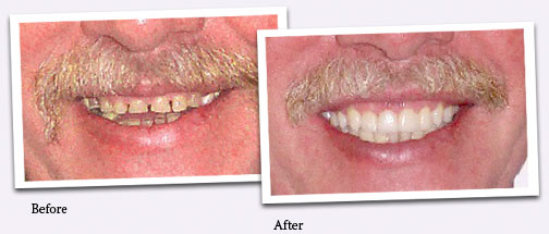 Before and after smile photos.